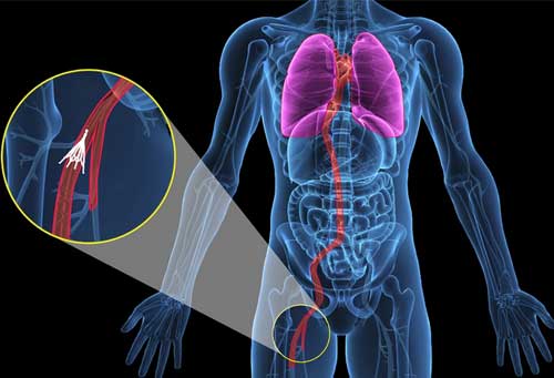 установка фильтра