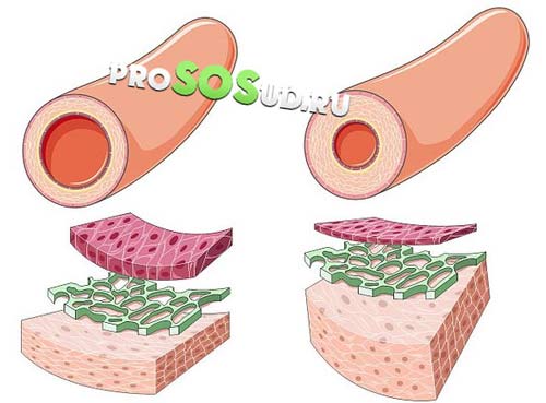 утолщение сосудистой стенки