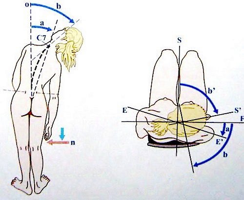 При анкилозирующем спондилоартрите важно сохранять подвижность суставов
