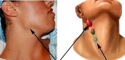 увеличенные лимфоузлы на шее