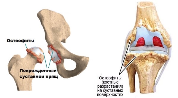 Назначают Диартрин при остеоартрозе коленного и тазобедренного сустава