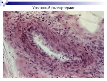 узелкового периартериита