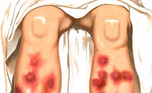 узловатая эритема на ногах