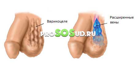 варикоцеле яичек
