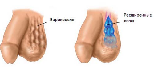 варикоцеле