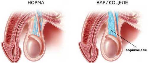 варикоцеле
