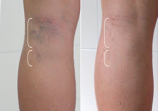 варикоз на ногах