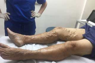 варикоз на ногах