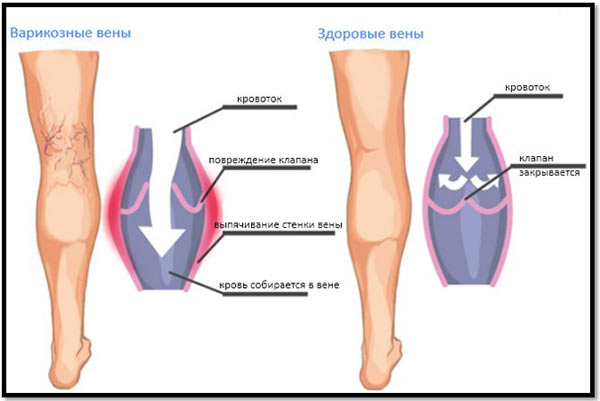 варикоз на ногах