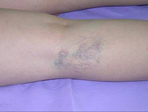 варикоз на ноге