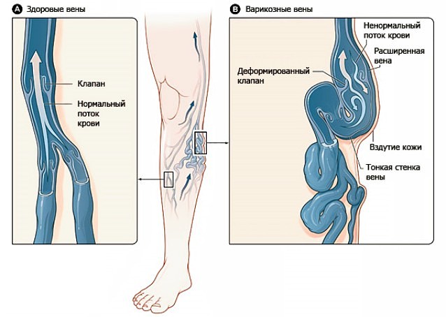 варикоз ног