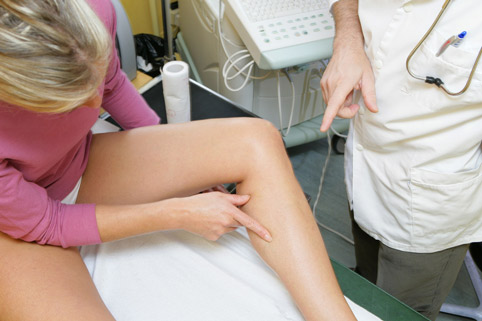 варикоз ног