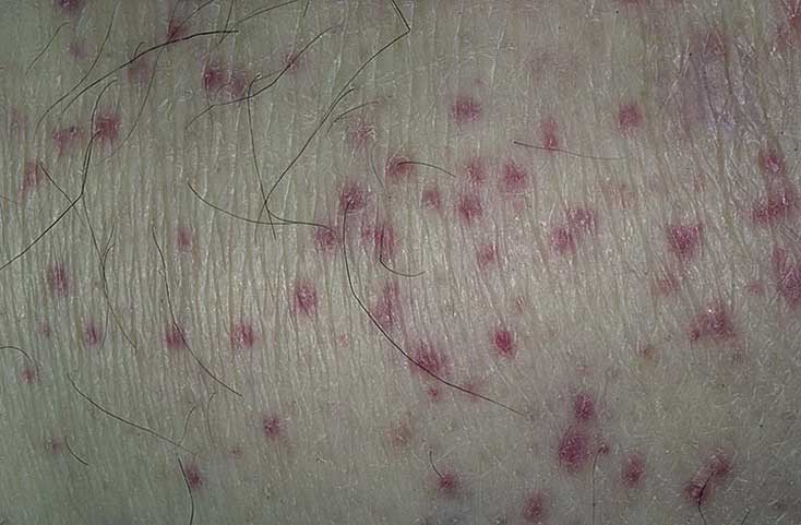 васкулит на коже