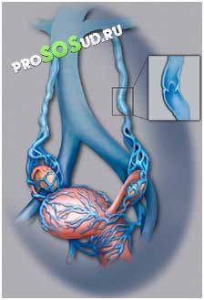 сосуды малого таза