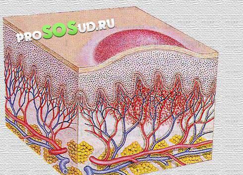 венозная ангиома