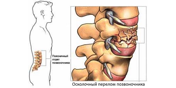 Осколочный перелом позвонков опасен тем, что может повредить спинной мозг