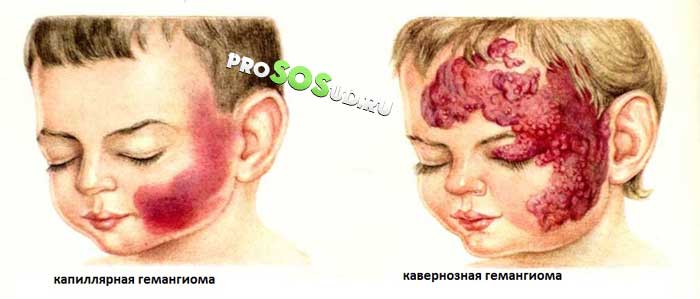виды гемангиом