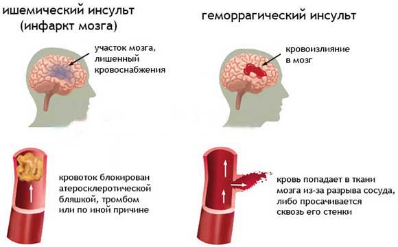 виды инсульта