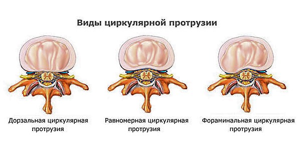 Подробнее о типах циркулярной протрузии можно узнать ниже