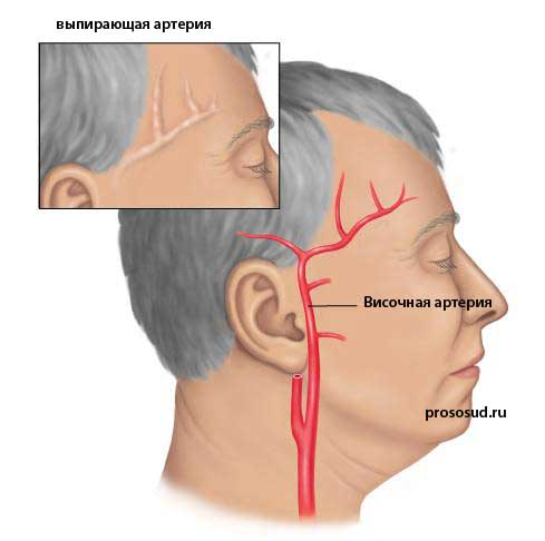 Выпирающая артерия на виске