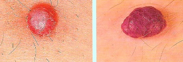 Вишневые ангиомы