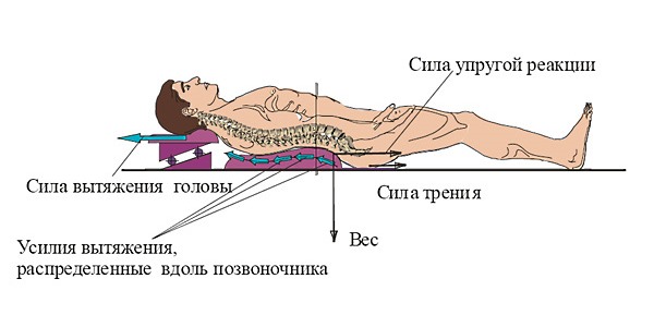 Один из методов терапии сколиоза - вытяжка позвоночника