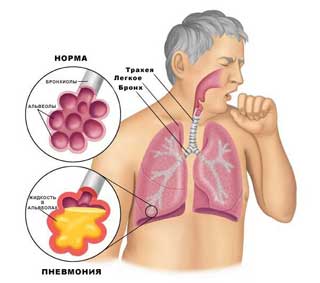 воспаление легких