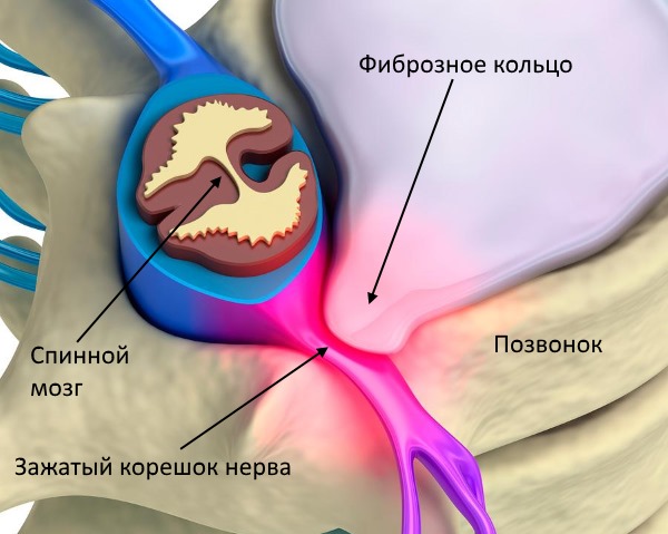Воспаление нервного корешка вызывает боль при радикулите