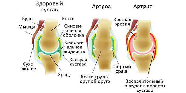 Назаначают Диклоран при воспалительных заболеваниях опорно-двигательного аппарата