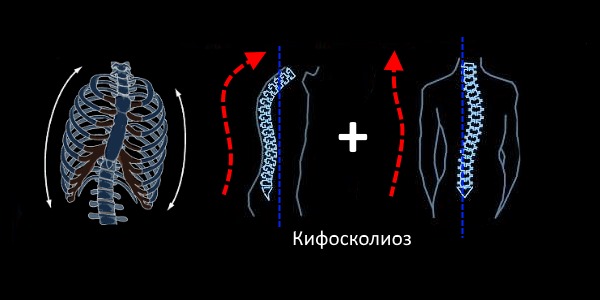 При кифосколиозе происходит искривление позвоночника в двух проекциях