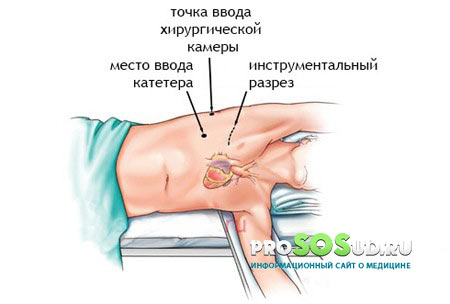 место введения катетера