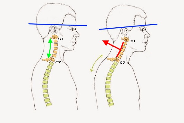 При гиполордозе происходит выпрямление изгиба назад
