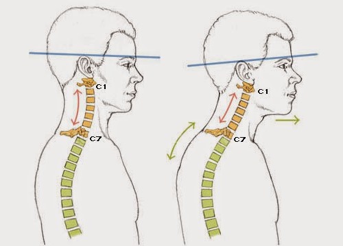 Ниже приведены основные симптомы лордоза в шейном отделе позвоночника