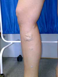 вздутые вены на ногах