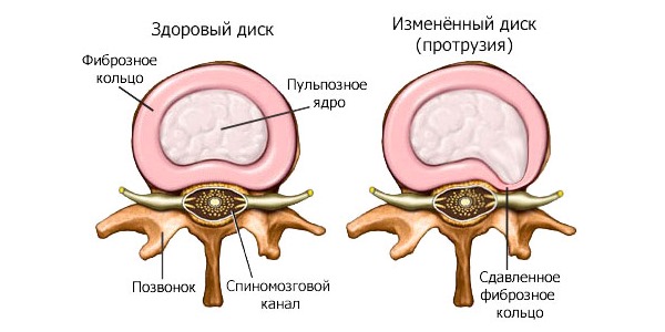 Выполнять гимнастику можно уже на первой стадии межпозвоночной грыжи