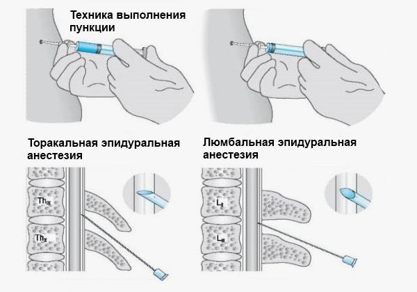 Введение анестетика может проводится в разных частях позвоночника, в зависимости от пораженного участка