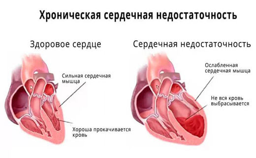хроническая сердечная недостаточность