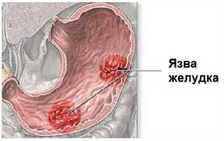 язва желудка