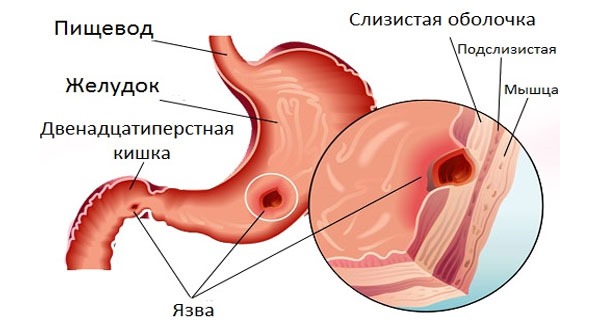 НПВС не назначают при язве желудка