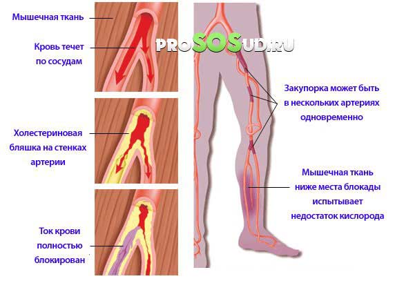забиты сосуды на ногах
