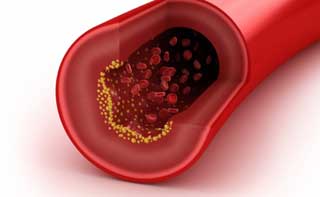 атеросклероз сосудов