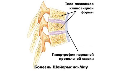 Болезнь Шейермана-Мау - частая причина шейного кифоза