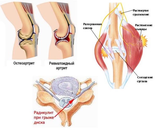 Часто Пенталгин принимают люди с суставными и мышечными болями