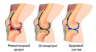 заболевания суставов