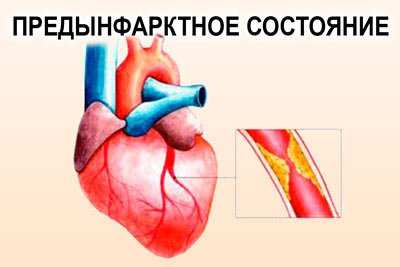 закупорка артерии сердца
