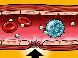 закупорка сосуда тромбоцитами