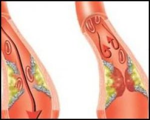 закупорка сосудов