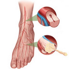 закупорка сосудов ног