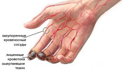 закупорка сосудов на руках