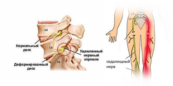 При защемлении нерва помимо чувства жжения могут онеметь конечности